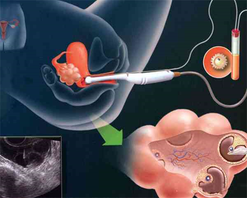 洗精,信阳三代供卵代怀助孕捐卵生孩子医院推荐